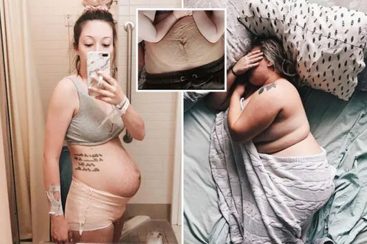 Real postpartum bloat in the first week after birth showing typical abdominal water retention
